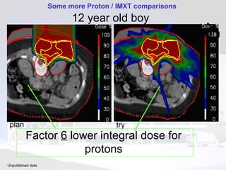 12 year old boy Delivered single field plan Some more Proton / IMXT comparisons  Unpublished data   9 field IMRT plan 9 field IMRT – second try Factor  6  lower integral dose for protons 
