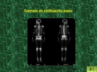 Exemplo de cintilografia óssea:
 