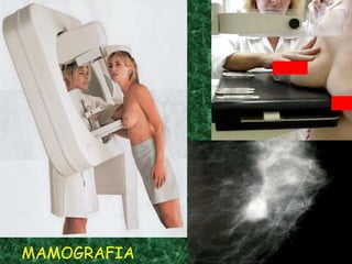 MAMOGRAFIA
 