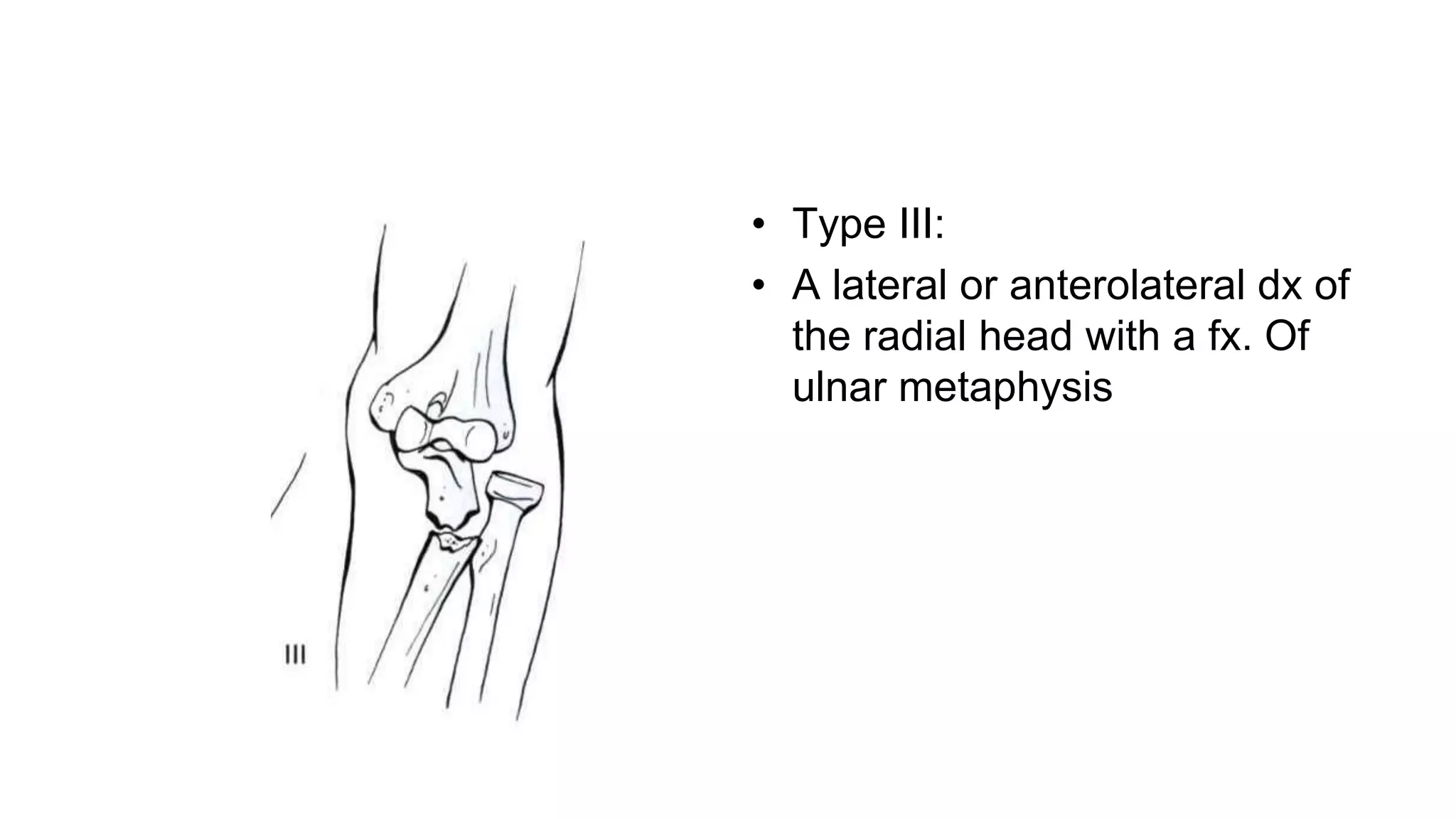 Radius and ulnar shaft fx | PPTX