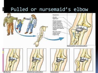 Pulled or nursemaid’s elbow
 