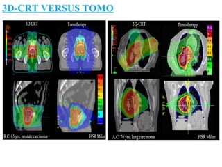 3D-CRT VERSUS TOMO
 