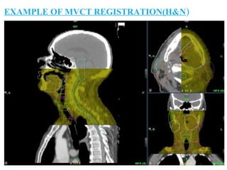 EXAMPLE OF MVCT REGISTRATION(H&N)
 