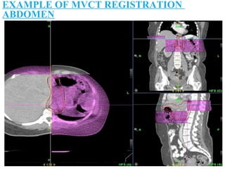 EXAMPLE OF MVCT REGISTRATION
ABDOMEN
 