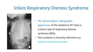 Glass Radiograph RADIOLOGICAL PATHOLOGY RESPIRATORY SYSTEM.pptx