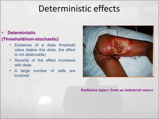 Deterministic effects 
• Deterministic 
(Threshold/non-stochastic) 
• Existence of a dose threshold 
value (below this dose, the effect 
is not observable) 
• Severity of the effect increases 
with dose 
• A large number of cells are 
involved 
Radiation injury from an industrial source 
 