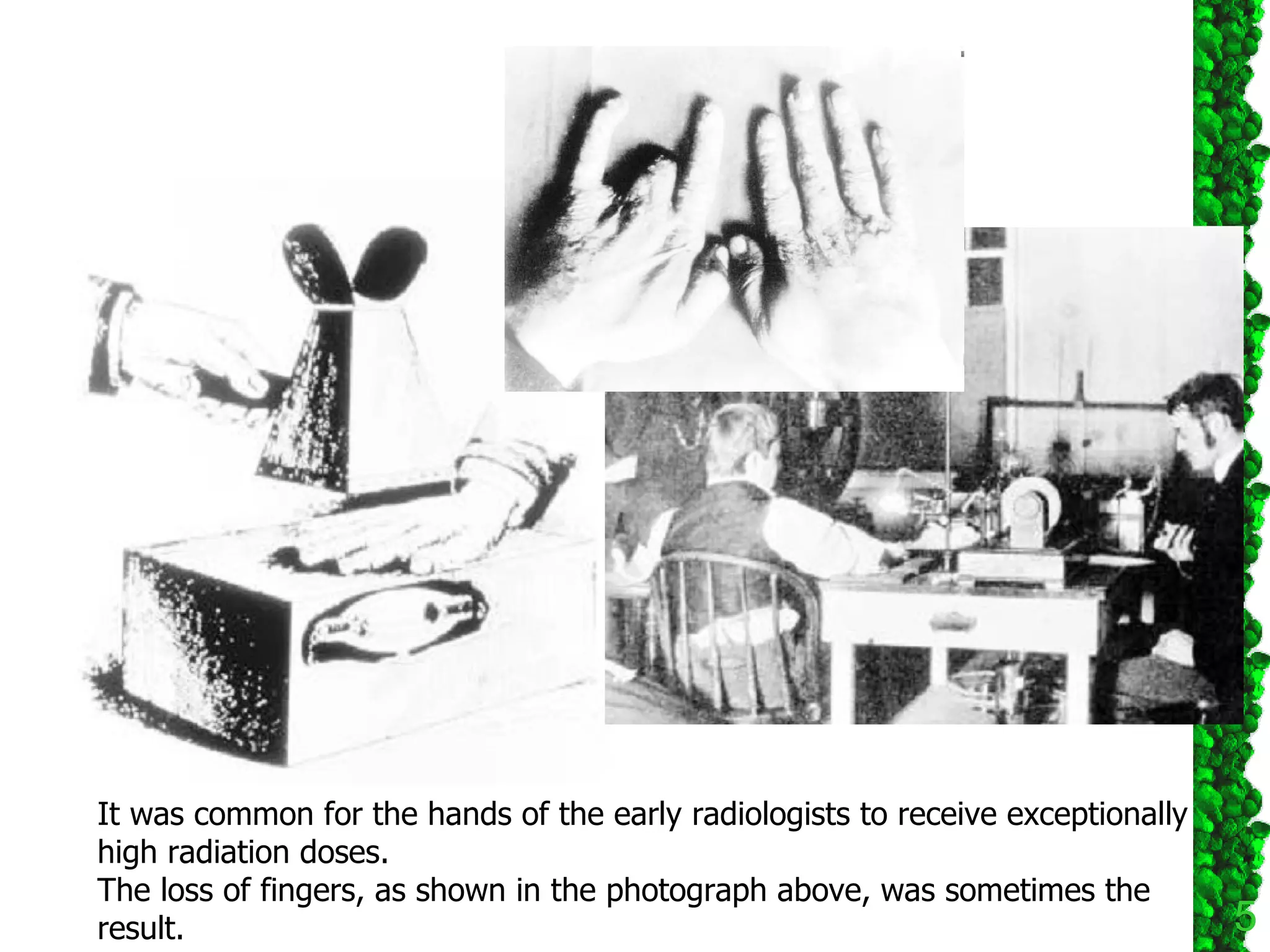 It was common for the hands of the early radiologists to receive exceptionally high radiation doses.  The loss of fingers, as shown in the photograph above, was sometimes the result.  