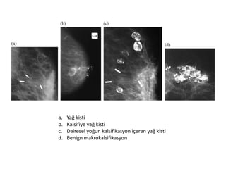 a.   Yağ kisti
b.   Kalsifiye yağ kisti
c.   Dairesel yoğun kalsifikasyon içeren yağ kisti
d.   Benign makrokalsifikasyon
 