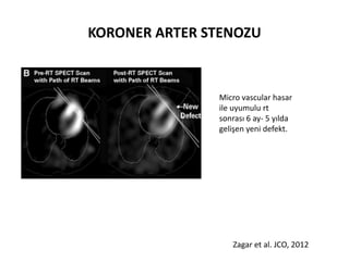 KORONER ARTER STENOZU



               Micro vascular hasar
               ile uyumulu rt
               sonrası 6 ay- 5 yılda
               gelişen yeni defekt.




                  Zagar et al. JCO, 2012
 