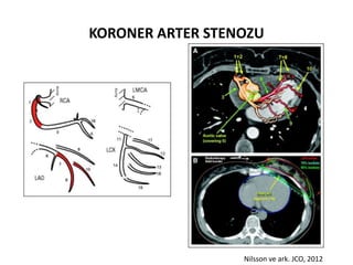 KORONER ARTER STENOZU




                  Nilsson ve ark. JCO, 2012
 