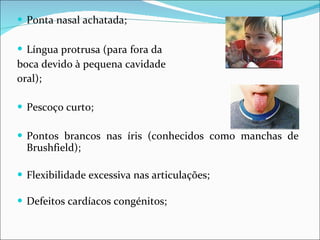 Ponta nasal achatada; Língua protrusa (para   fora da  boca devido à pequena cavidade  oral); Pescoço curto; Pontos brancos nas íris (conhecidos como manchas de Brushfield); Flexibilidade excessiva nas articulações;  Defeitos cardíacos congénitos; 