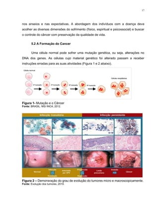 17
nos anseios e nas expectativas. A abordagem dos indivíduos com a doença deve
acolher as diversas dimensões do sofrimento (físico, espiritual e psicossocial) e buscar
o controle do câncer com preservação da qualidade de vida.
5.2 A Formação do Cancer
Uma célula normal pode sofrer uma mutação genética, ou seja, alterações no
DNA dos genes. As células cujo material genético foi alterado passam a receber
instruções erradas para as suas atividades (Figura 1 e 2 abaixo).
Figura 1- Mutação e o Câncer
Fonte: BRASIL. MS/ INCA, 2012.
Figura 2 – Demonsração do grau de evolução do tumores micro e macroscopicamente.
Fonte: Evolução dos tumores, 2019.
 