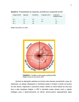 25
Quadro 6 - Probabilidades de regressão, persistência e progressão da NIC
Fonte: SELLORS et al, 2004.
FIGURA 5 - Lesões e seus graus conforme NIC.
Fonte: Lesoes do colo uterino, 2019.
Quando as alterações celulares se tornam mais intensas aumentando o grau do
desarranjo, as células ultrapassam a membrana basal e invadem o tecido con-juntivo
do colo uterino, originando o carcinoma invasor. Dentre os vários fatores de risco que
leva a esta neoplasia maligna, o HPV é apontado quase sempre como o agente
etiológico para o desenvolvimento do câncer cérvico-uterino especialmente pelos
 