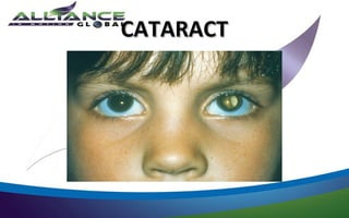 CATARACT
 