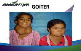 GOITER
 