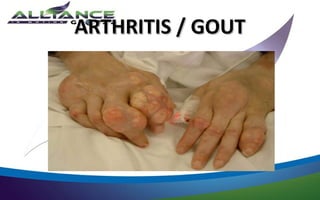 ARTHRITIS / GOUT
 