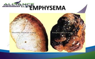 EMPHYSEMA
 