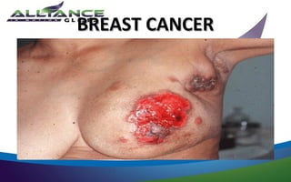 BREAST CANCER
 
