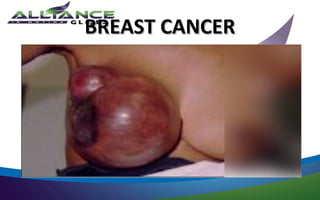 BREAST CANCER
 