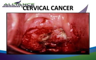 CERVICAL CANCER
 