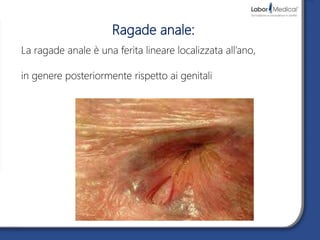 Ragade anale:
La ragade anale è una ferita lineare localizzata all’ano,
in genere posteriormente rispetto ai genitali
 
