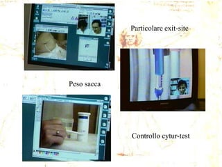 Particolare exit-site

Peso sacca

Controllo cytur-test

 