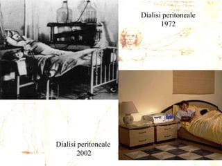 Dialisi peritoneale
1972

Dialisi peritoneale
2002

 