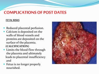 COMPLICATIONS OF POST DATES
FETAL RISKS
 Reduced placental perfusion.
 Calcium is deposited on the
walls of blood vessels and
proteins are deposited on the
surface of the placenta.
(CALCIFICATION)
 Limits the blood flow through
the placenta and ultimately
leads to placental insufficiency
and
 Fetus is no longer properly
nourished.
 