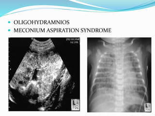  OLIGOHYDRAMNIOS
 MECONIUM ASPIRATION SYNDROME
 