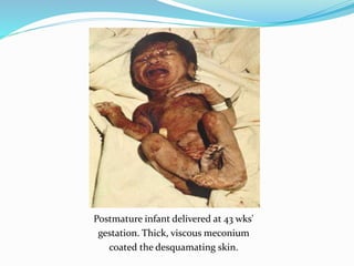 Postmature infant delivered at 43 wks'
gestation. Thick, viscous meconium
coated the desquamating skin.
 