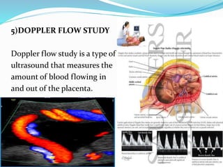 5)DOPPLER FLOW STUDY
Doppler flow study is a type of
ultrasound that measures the
amount of blood flowing in
and out of the placenta.
 