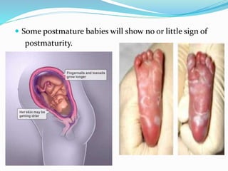  Some postmature babies will show no or little sign of
postmaturity.
 