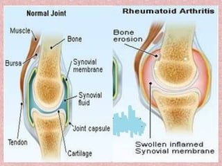 Gout Racgp RA & gout.ppt RA & gout.ppt RA & gout.ppt