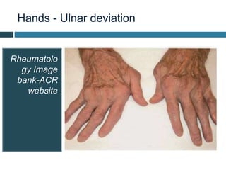 Hand Deviation Rheumatoid arthritis | PPTX