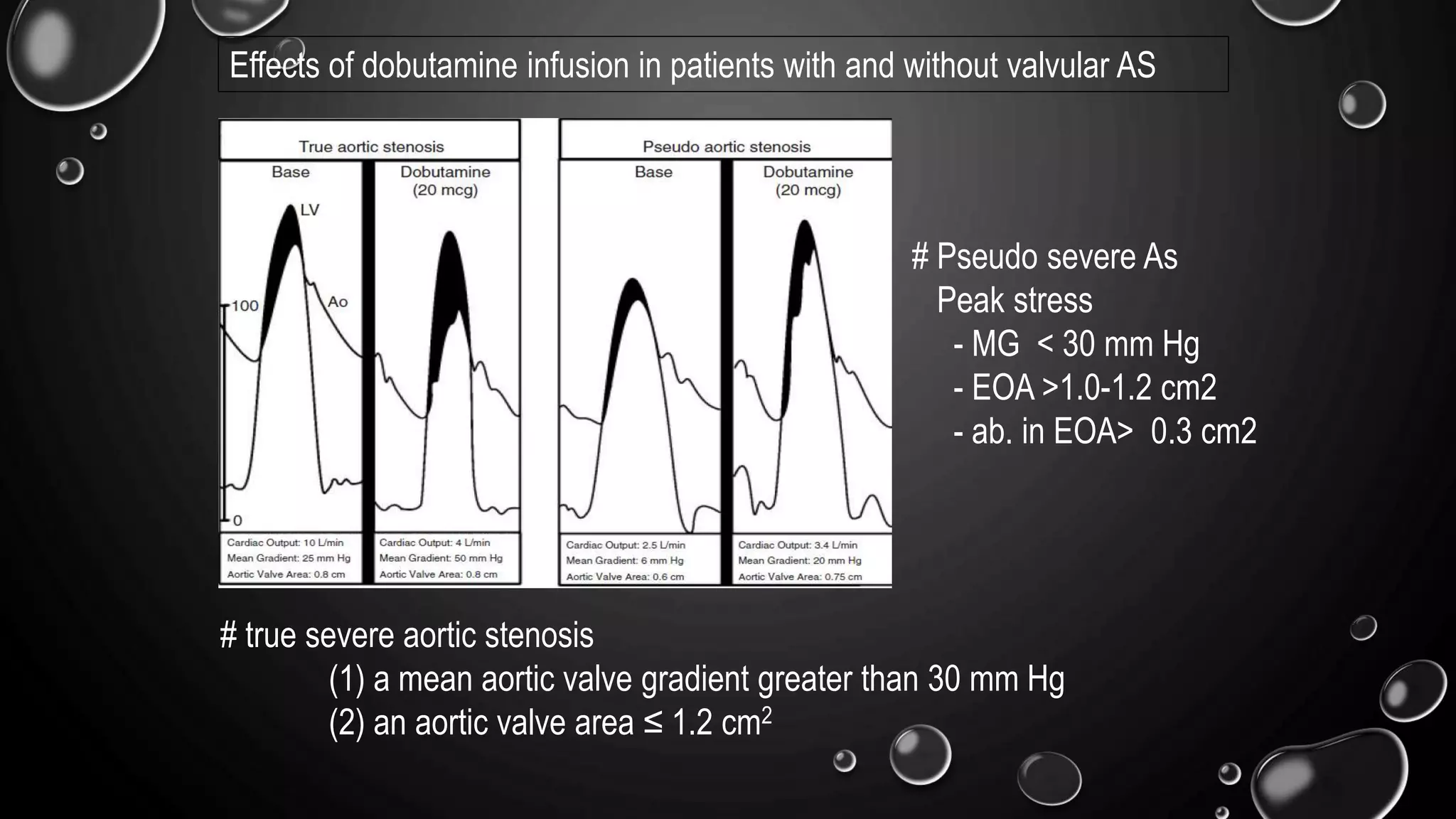 # true severe aortic stenosis
(1) a mean aortic valve gradient greater than 30 mm Hg
(2) an aortic valve area ≤ 1.2 cm2
Effects of dobutamine infusion in patients with and without valvular AS
# Pseudo severe As
Peak stress
- MG < 30 mm Hg
- EOA >1.0-1.2 cm2
- ab. in EOA> 0.3 cm2
 