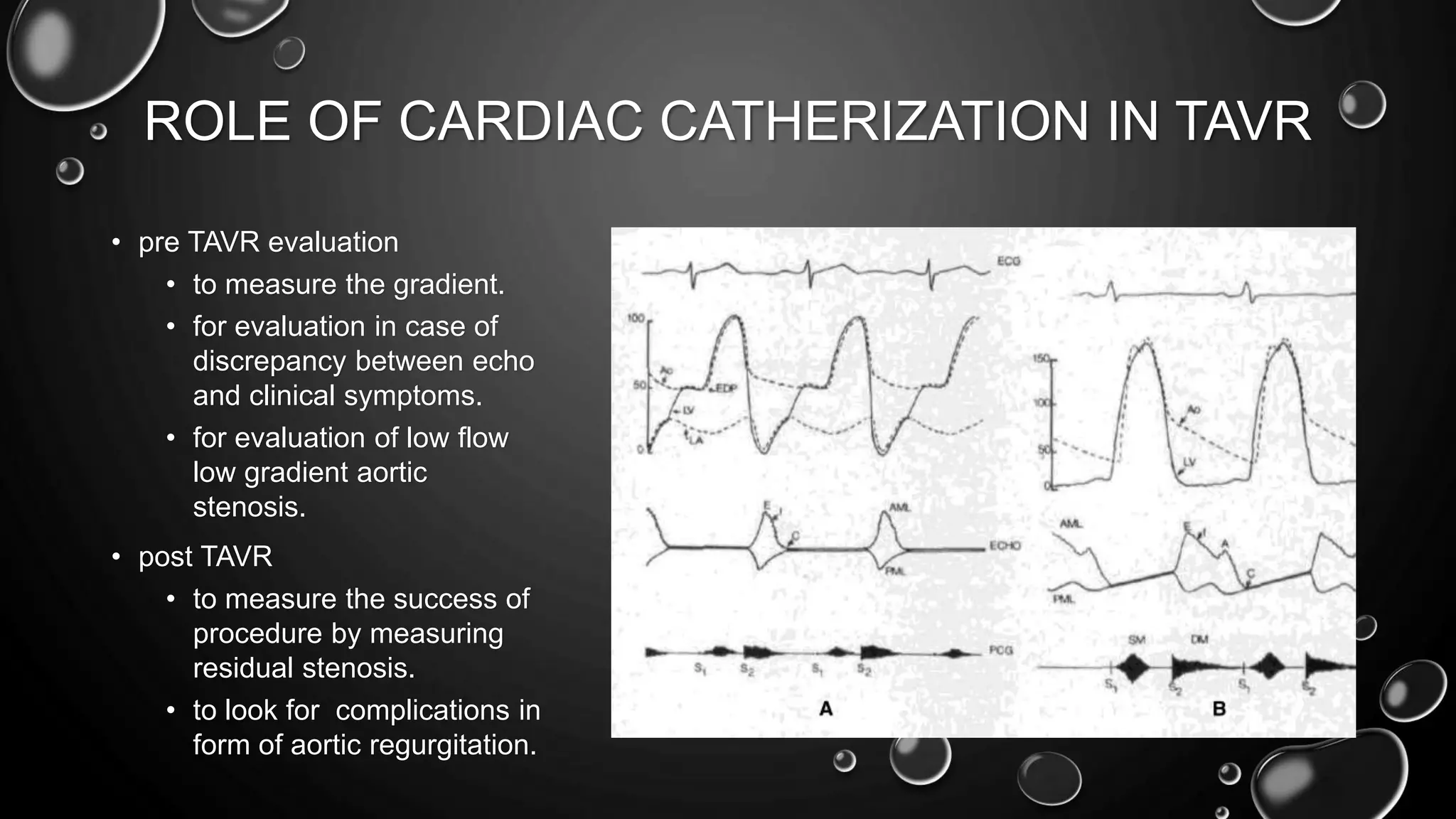 ROLE OF CARDIAC CATHERIZATION IN TAVR
• pre TAVR evaluation
• to measure the gradient.
• for evaluation in case of
discrepancy between echo
and clinical symptoms.
• for evaluation of low flow
low gradient aortic
stenosis.
• post TAVR
• to measure the success of
procedure by measuring
residual stenosis.
• to look for complications in
form of aortic regurgitation.
 