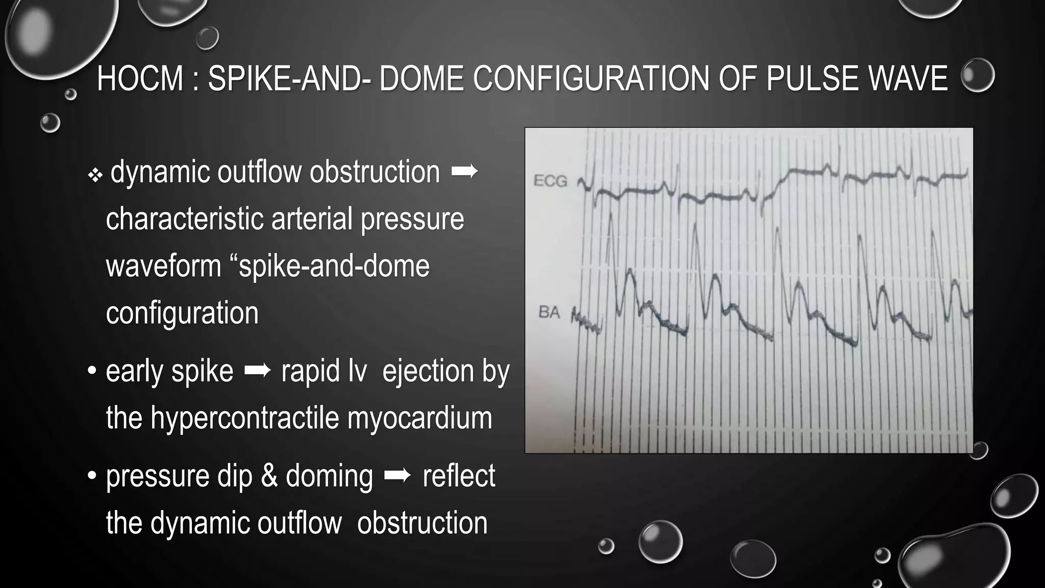 HOCM : SPIKE-AND- DOME CONFIGURATION OF PULSE WAVE
 dynamic outflow obstruction ➨
characteristic arterial pressure
waveform “spike-and-dome
configuration
• early spike ➨ rapid lv ejection by
the hypercontractile myocardium
• pressure dip & doming ➨ reflect
the dynamic outflow obstruction
 