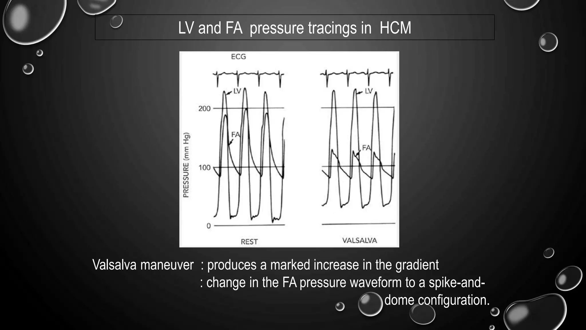 Valsalva maneuver : produces a marked increase in the gradient
: change in the FA pressure waveform to a spike-and-
dome configuration.
LV and FA pressure tracings in HCM
 