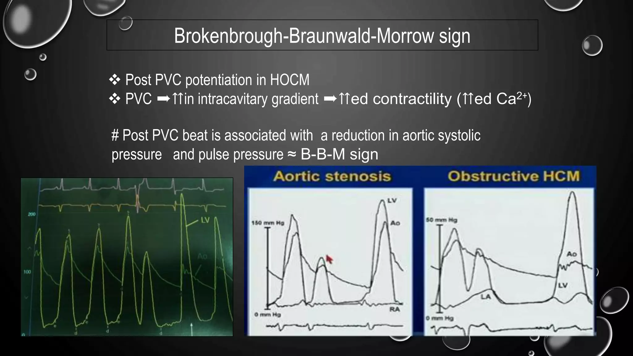 Brokenbrough-Braunwald-Morrow sign
 Post PVC potentiation in HOCM
 PVC ➨⇈in intracavitary gradient ➨⇈ed contractility (⇈ed Ca2+)
# Post PVC beat is associated with a reduction in aortic systolic
pressure and pulse pressure ≈ B-B-M sign
 