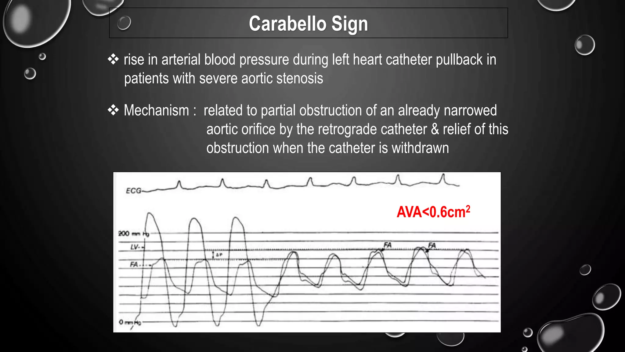 Carabello Sign
 rise in arterial blood pressure during left heart catheter pullback in
patients with severe aortic stenosis
 Mechanism : related to partial obstruction of an already narrowed
aortic orifice by the retrograde catheter & relief of this
obstruction when the catheter is withdrawn
AVA<0.6cm2
 