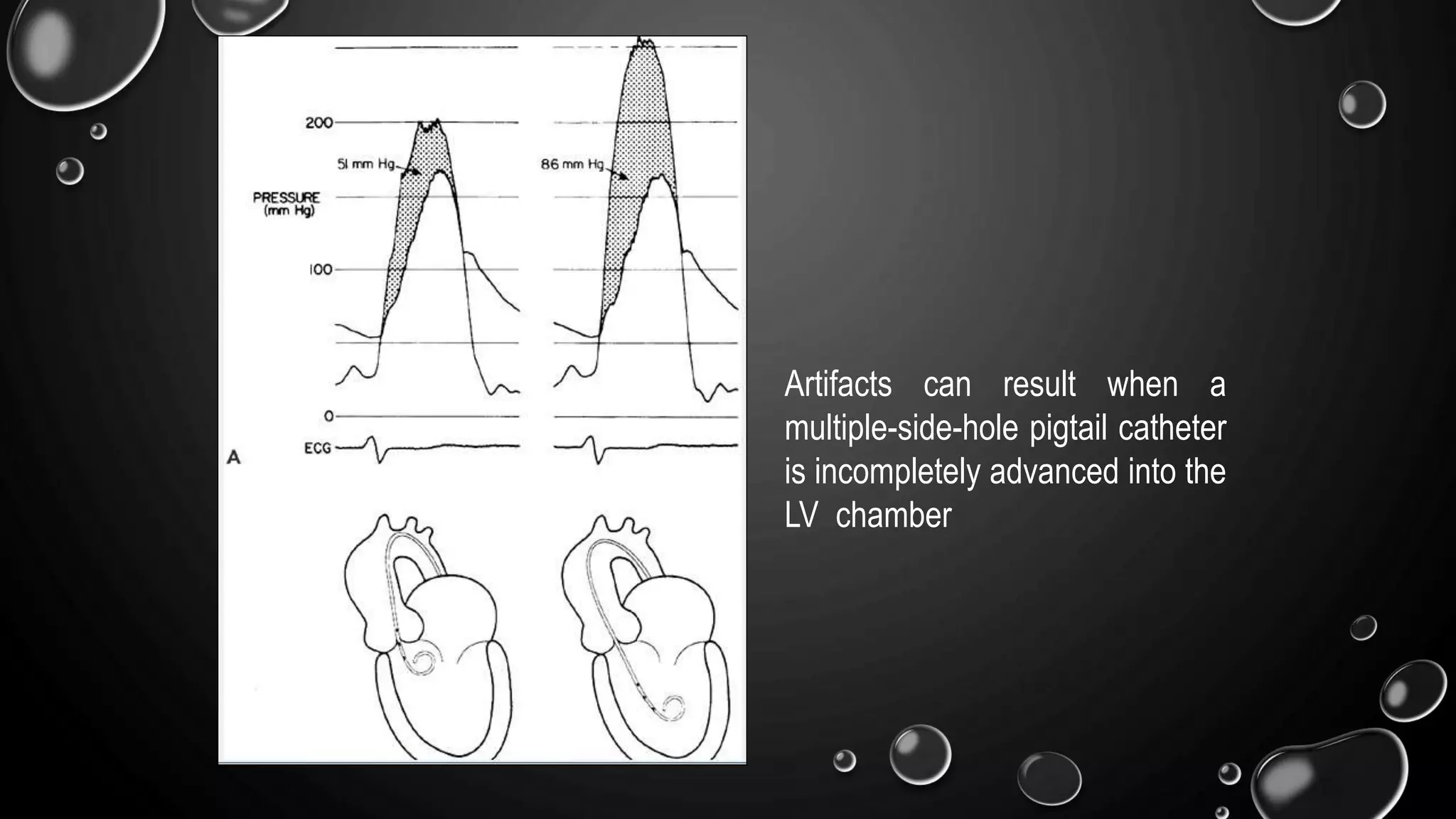 Artifacts can result when a
multiple-side-hole pigtail catheter
is incompletely advanced into the
LV chamber
 