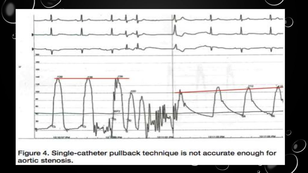 hemodynamic in cath lab aortic stenosis and hocm