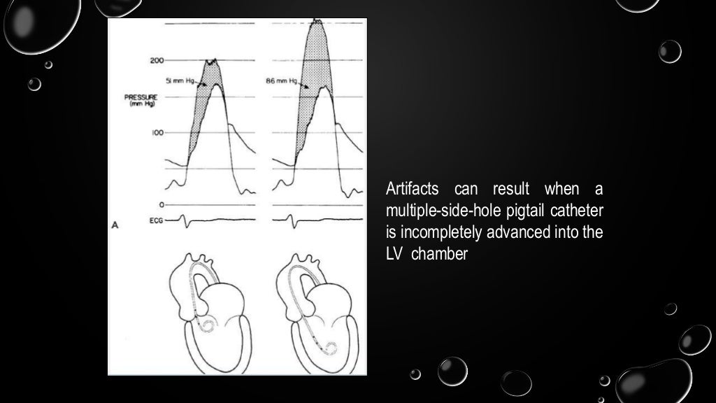 hemodynamic in cath lab aortic stenosis and hocm