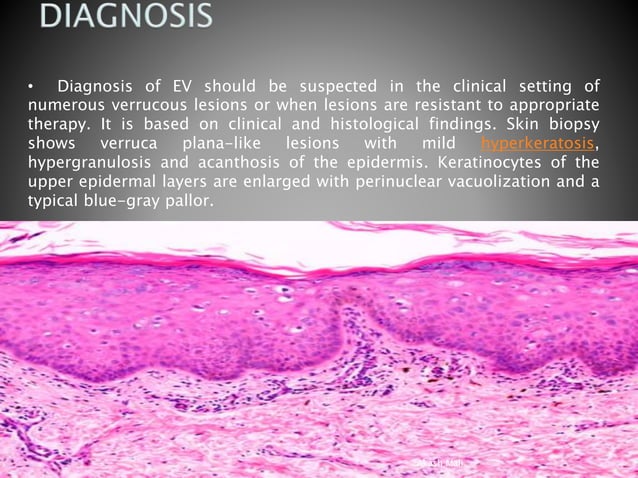 Mutation Gene Disorders Epidermodysplasia verruciformis | PPTX | Skin ...