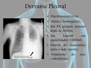 Derrame Pleural
• Hipotransparência;
• Denso e homogêneo;
• Em PA quando possuir
mais de 300ml;
• Em Laurell em
quantidades <300ml;
• Desvio do mediastino
para o lado oposto;
• Velamento do seio
costofrênico.
 