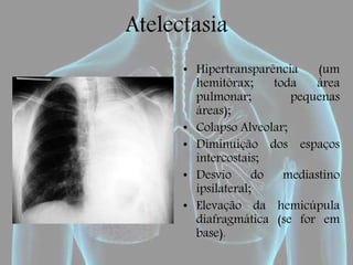 Atelectasia
• Hipertransparência (um
hemitórax; toda área
pulmonar; pequenas
áreas);
• Colapso Alveolar;
• Diminuição dos espaços
intercostais;
• Desvio do mediastino
ipsilateral;
• Elevação da hemicúpula
diafragmática (se for em
base).
 