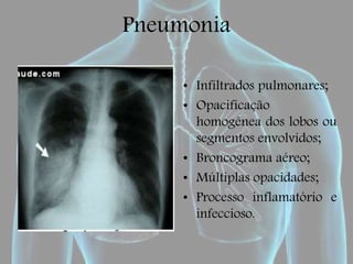 Pneumonia
• Infiltrados pulmonares;
• Opacificação
homogênea dos lobos ou
segmentos envolvidos;
• Broncograma aéreo;
• Múltiplas opacidades;
• Processo inflamatório e
infeccioso.
 