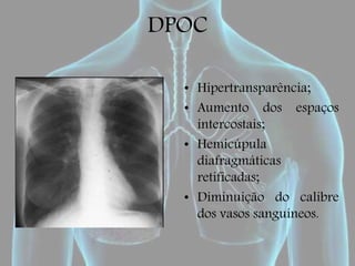 DPOC
• Hipertransparência;
• Aumento dos espaços
intercostais;
• Hemicúpula
diafragmáticas
retificadas;
• Diminuição do calibre
dos vasos sanguíneos.
 