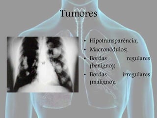 Tumores
• Hipotransparência;
• Macronódulos;
• Bordas regulares
(benigno);
• Bordas irregulares
(maligno);
 