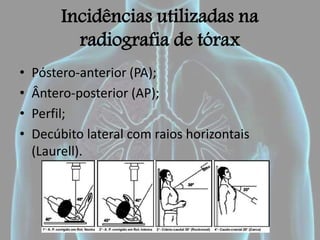 Incidências utilizadas na
radiografia de tórax
• Póstero-anterior (PA);
• Ântero-posterior (AP);
• Perfil;
• Decúbito lateral com raios horizontais
(Laurell).
 
